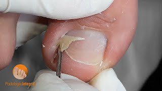 Ingrown toenail amp granuloma podologiaintegral [upl. by Sone]