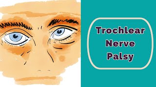 Trochlear Nerve Palsy Rapid Review [upl. by Fabi]