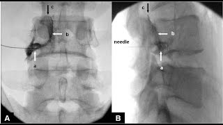 5 Minute Lumbar Medial Branch Radiofrequency Ablation [upl. by Qifahs810]