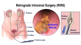 What is RIRS amp How Retrograde Intrarenal Surgery Removes Kidney Stones [upl. by Noiwtna]