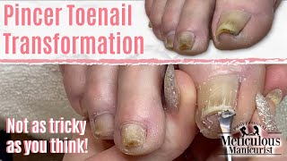 How to Fix Ingrown Toenail Pincer Nails Caused Nail Fungus Pedicure Tutorial [upl. by Ecirtal]