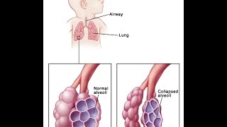 Respiratory Distress Syndrome [upl. by Indys608]