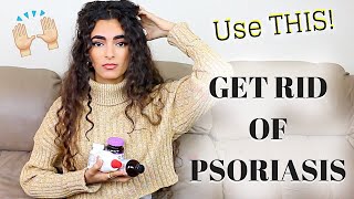 HOW TO GET RID OF PSORIASIS SERIOUSLY [upl. by Ezzo458]