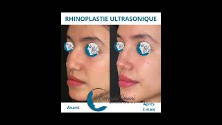 Rhinoplastie ultrasonique au bloc avant et après preservationrhinoplasty rhinoexpert [upl. by Magnuson822]