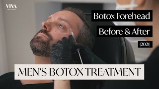 Botox Forehead Before and After 2021  Mens Botox Treatment [upl. by Hitchcock]