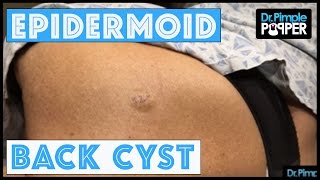 An Epidermoid Cyst Lets cure it with a curette [upl. by Harrow]