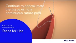 Introduction to the VLoc™ Wound Closure Device Video Guide [upl. by Iahs]