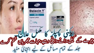 Best Acne Lotion  Dalacin T Lotion  Calindamycin 1 Acne Lotion Review In Urdu Hindi [upl. by Eugenius336]