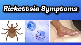 Rickettsia Symptoms [upl. by Naejeillib]