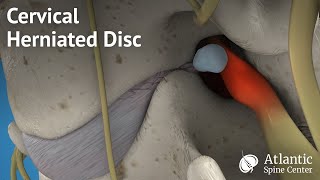 Herniated Disc Repair  UW Medicine [upl. by Kendrah]