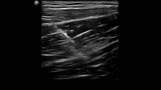 Groin Ultrasound Adductor Tendon Sheath Injection [upl. by Nosyarg]