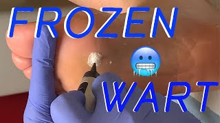 FROZEN WART [upl. by Darrin]