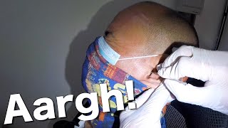 Mans Painful Earwax Removal [upl. by Baird516]