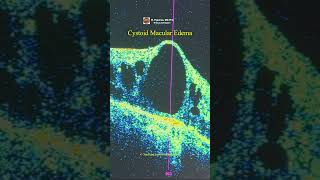 Cystoid Macular Edema OCT [upl. by Sumer]