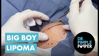 The Big Boy Lipoma [upl. by Daza740]