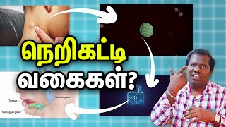 Types of Lymph node நெறிகட்டி வகைகள் Dr Narendran [upl. by Leupold682]