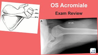 OS Acromiale Exam Review  Jay Keener MD [upl. by Utham]