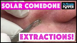 Great BLACKHEAD Extractions [upl. by Sucrad733]