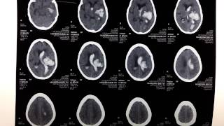 CT Scan Intracerebral Hemorrhage with Intraventricular Extension  Hemorrhagic Stroke on CT Scan [upl. by Octavia278]