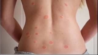 Pityriasis Rosea [upl. by Vernen]