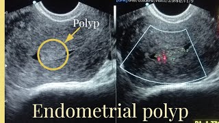 Ultrasound Report of endometrial polyp Sonography of Endometrial masspolyp [upl. by Nalyk297]