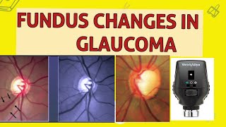 OPTIC DISC CHANGES IN GLAUCOMA [upl. by Annehsat]