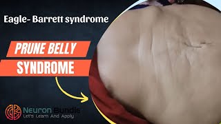 Prune belly syndrome  Abdominal wall defect  congenital anomalies [upl. by Portia269]