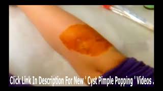 Giant nasty cyst vs boil popping  YouTube [upl. by Alset]