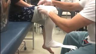 Applying a patella tendon bearing PTB cast [upl. by Ellenij781]