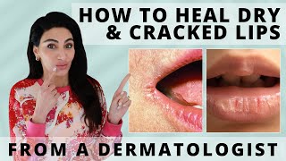 How to Heal Dry amp Cracked Lips Fast  Dermatologist Reveals [upl. by Josey494]