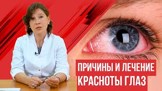 Покраснение глаз Причины и лечение красноты глаз [upl. by Meela]