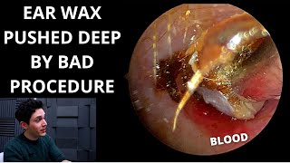 Ear Wax  Which Ear Drops are the best [upl. by Cheria]