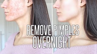 How To Get Rid Of Pimples OVERNIGHT [upl. by Emmott]