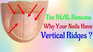 The REAL Reasons Why Your Nails Have Vertical How to Treat and Fix Vertical Ridges [upl. by Thorpe]