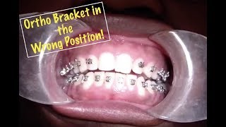 Orthodontic Bracket Repositioning [upl. by Terza]