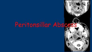 Peritonsillar Abscess [upl. by Oswin]