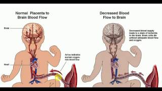 PAEDIATRICS LECTURES  Hypoxic Ischemic Encephalopathy [upl. by Idel]