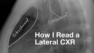 How I Read a Lateral CXR [upl. by Liuqa]