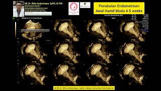 Penebalan Endometrium 45 weeks [upl. by Nrev]