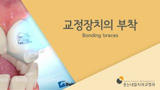 교정장치의 부착 Bonding braces [upl. by Vaish]