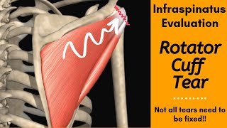 Infraspinatus Tear Evaluation Special tests and Manual Muscle Testing [upl. by Hammond]