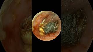 COMPLETE Package Of Earwax With Fungi [upl. by Huttan219]