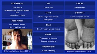 Turner Syndrome Dysmorphic Features [upl. by Aamsa32]