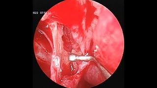 ESPAL  Endoscopic Sphenopalatine Artery Ligation  Cautery [upl. by Goodman]