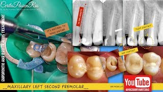 root canal treatment  endodontic treatment on long premolar  squirt obturation [upl. by Latisha]