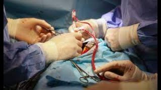 CABG surgery procedure [upl. by Congdon]