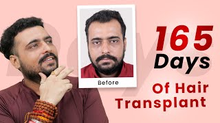 0 TO 165 DAYS HAIR TRANSPLANT RESULTS  HAIR TRANSPLANT [upl. by Torray]