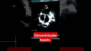 Single Ventricleuniventricular hearts congenital heart defect CHDuniventricular hearts [upl. by Malha]