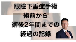 📷眼瞼下垂症手術後の腫れの経過：手術直後から2年後まで追跡👨‍⚕️ [upl. by Snow]