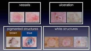 Dermatoscopic criteria of basal cell carcinoma basic [upl. by Alcinia]